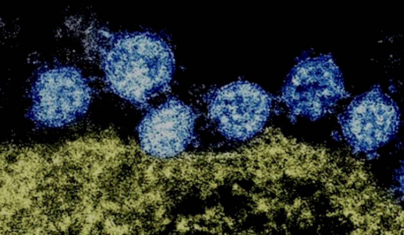 Coronavirus Wuhan et cellule humaine.
